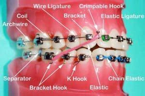 dental wire with metal brackets around molar|broken arch wire in braces.